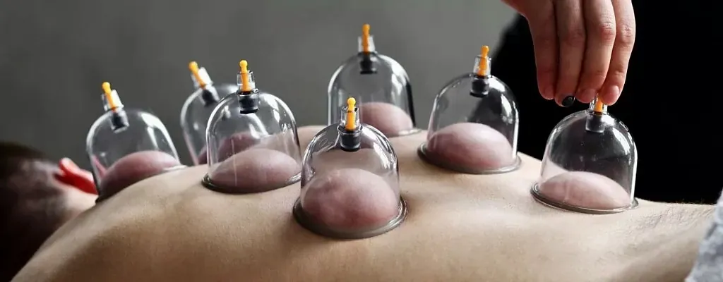 Traitement cupping sur le dos
